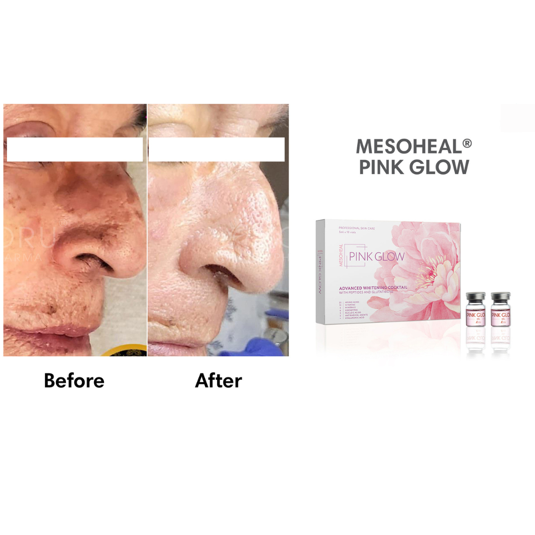 Mesoheal Pink Glow (5ml X 10 Vials)